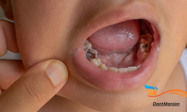 Understanding Cavities: Natural Appearance and Treatment