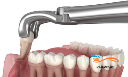 The surgical extraction of wisdom teeth & its process